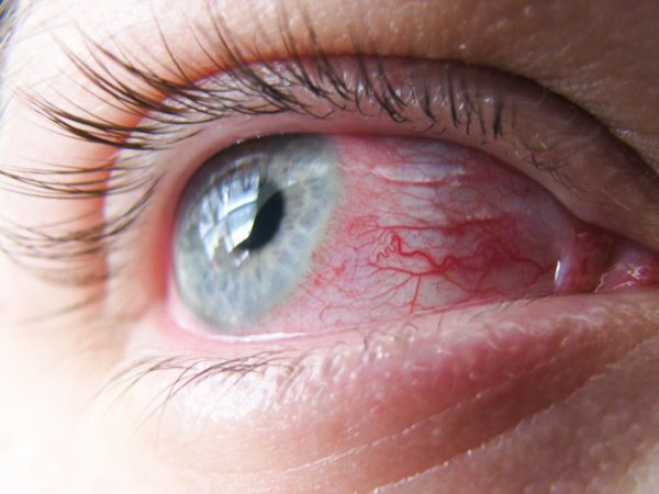  Konjunktivitis